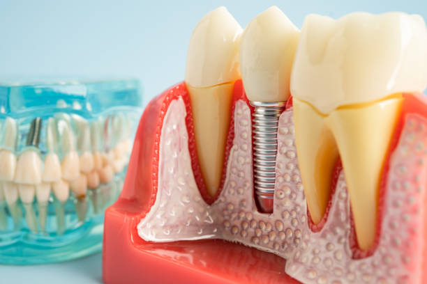 Best Dental Inlays and Onlays  in Dickinson, ND